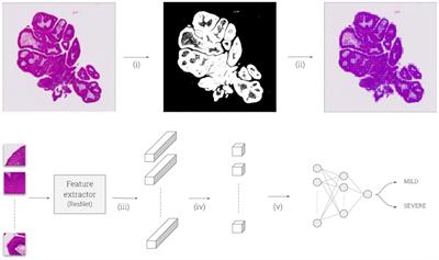 Histological Severity Risk Factors Identification in Juvenile-Onset Recurrent Respiratory Papillomatosis: How Immunohistochemistry and AI Algorithms Can Help?